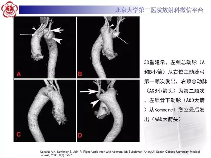 【病例】右位主动脉弓合并迷走左锁骨下动脉1例CT