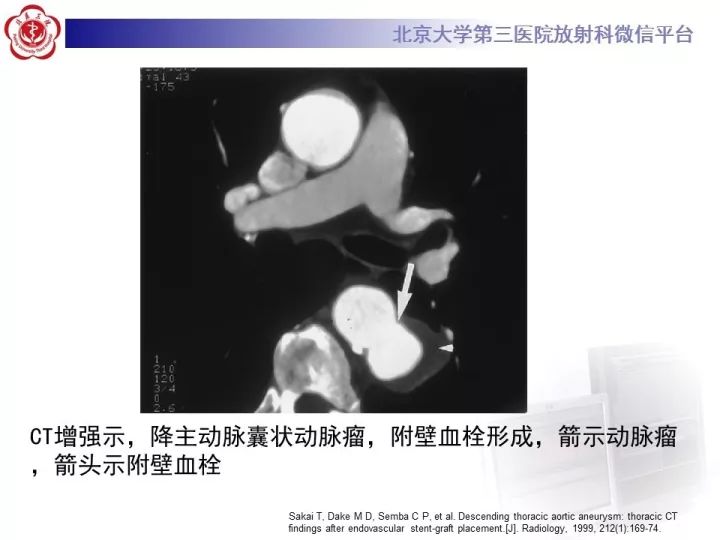 【病例】右位主动脉弓合并迷走左锁骨下动脉1例CT