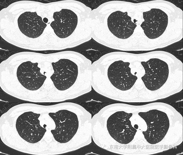 【病例】气管肿瘤2例CT影像诊断