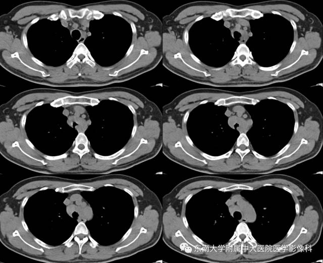 【病例】气管肿瘤2例CT影像诊断