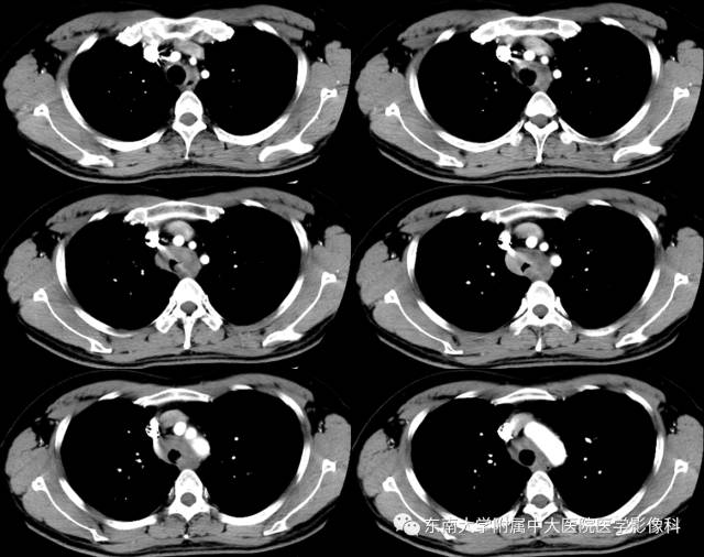 【病例】气管肿瘤2例CT影像诊断