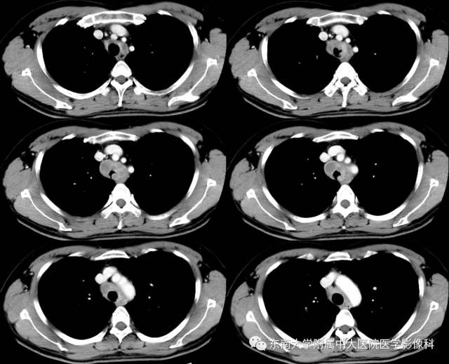 【病例】气管肿瘤2例CT影像诊断