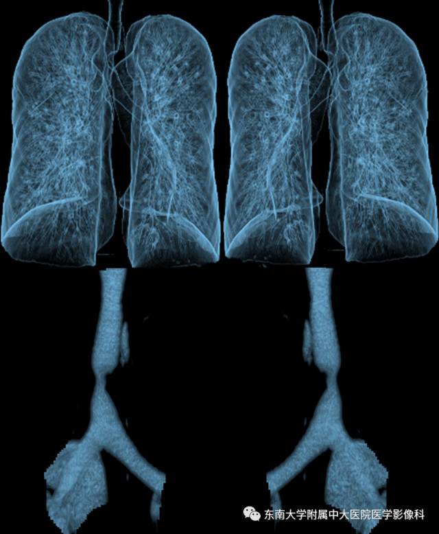 【病例】气管肿瘤2例CT影像诊断