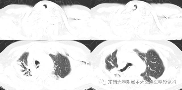 【病例】气管肿瘤2例CT影像诊断