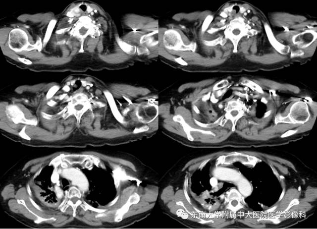 【病例】气管肿瘤2例CT影像诊断