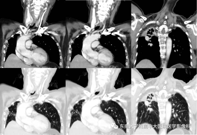 【病例】气管肿瘤2例CT影像诊断