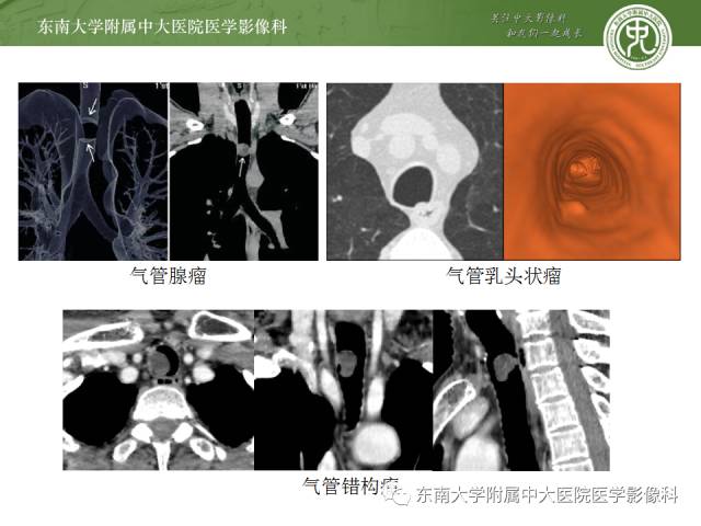 【病例】气管肿瘤2例CT影像诊断