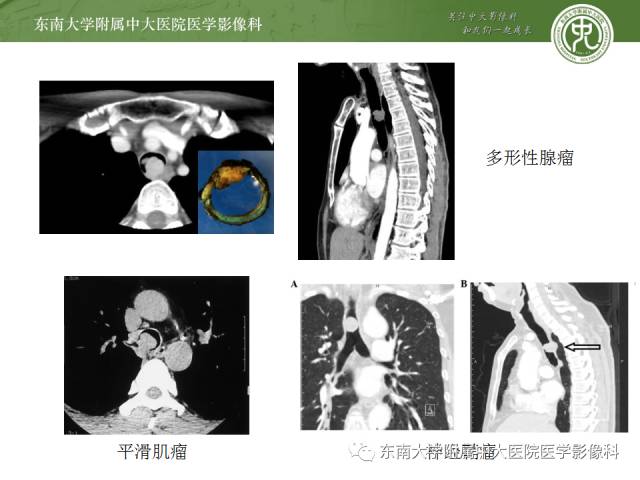 【病例】气管肿瘤2例CT影像诊断
