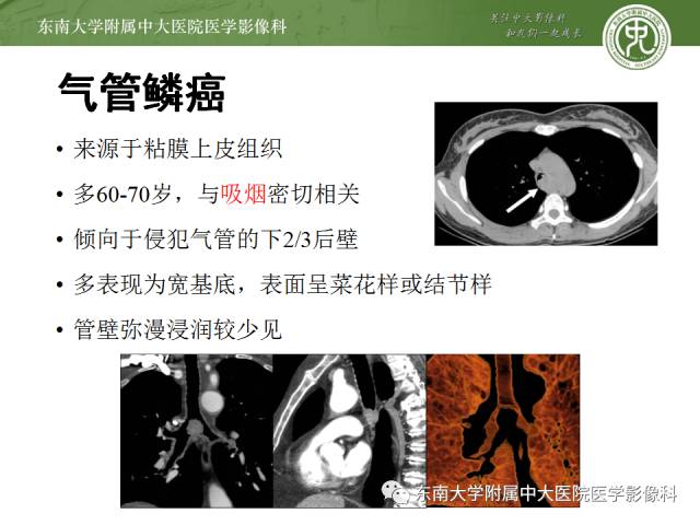 【病例】气管肿瘤2例CT影像诊断