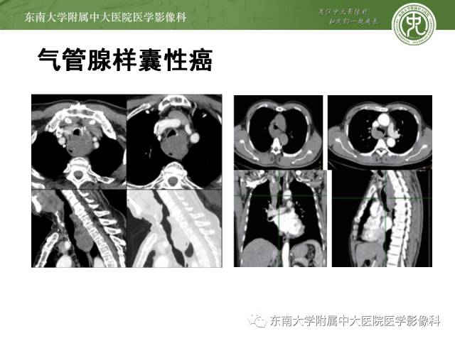 【病例】气管肿瘤2例CT影像诊断