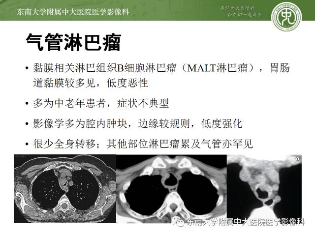 【病例】气管肿瘤2例CT影像诊断