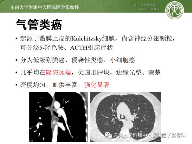 【病例】气管肿瘤2例CT影像诊断