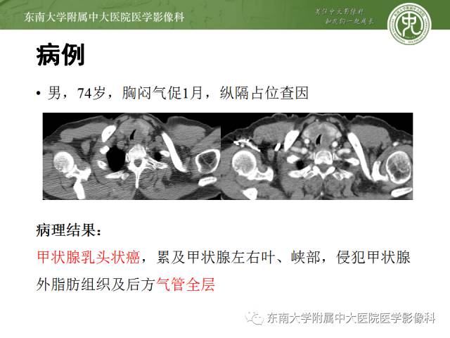 【病例】气管肿瘤2例CT影像诊断