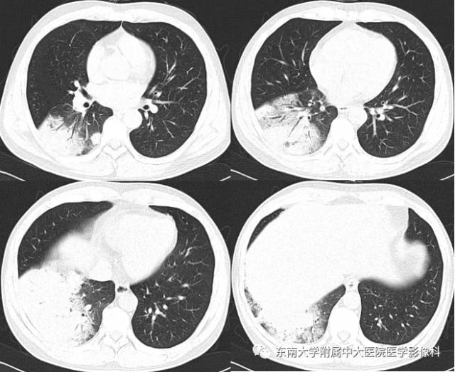 【病例】肺隐球菌病1例CT影像表现