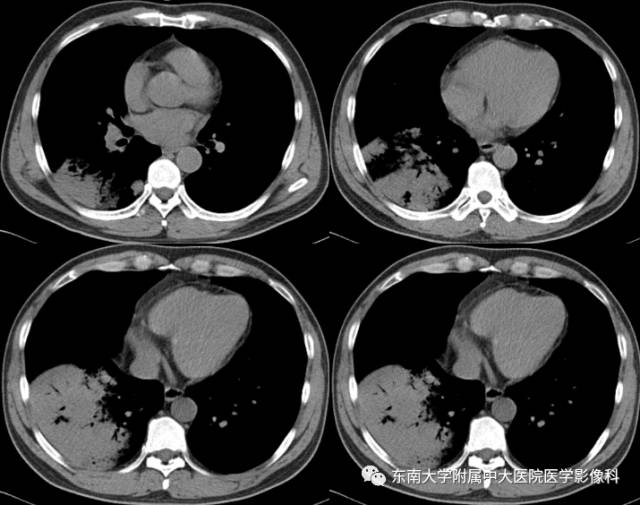 【病例】肺隐球菌病1例CT影像表现