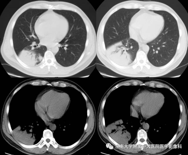 【病例】肺隐球菌病1例CT影像表现