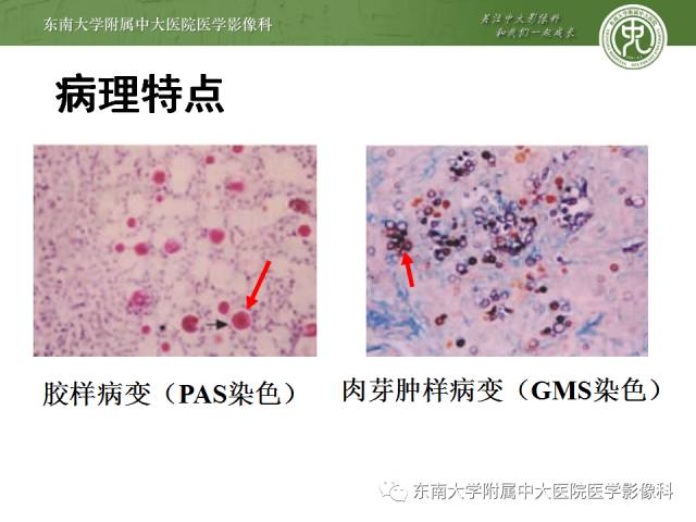 【病例】肺隐球菌病1例CT影像表现
