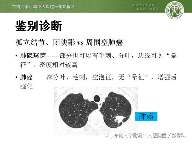 【病例】肺隐球菌病1例CT影像表现