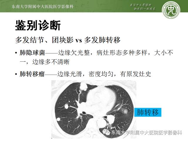 【病例】肺隐球菌病1例CT影像表现