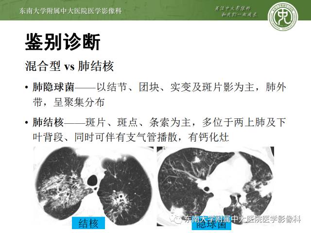 【病例】肺隐球菌病1例CT影像表现