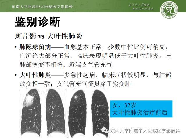 【病例】肺隐球菌病1例CT影像表现