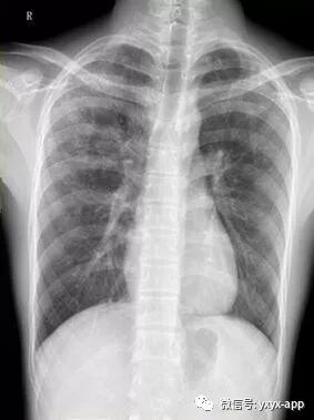 【病例】肺泡蛋白沉积症1例CT影像表现