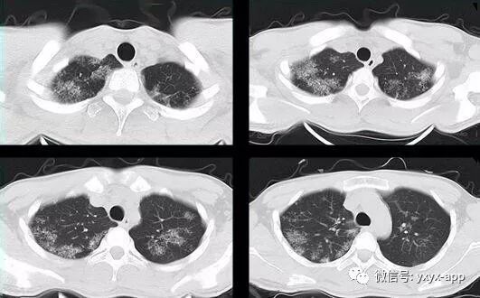 【病例】肺泡蛋白沉积症1例CT影像表现