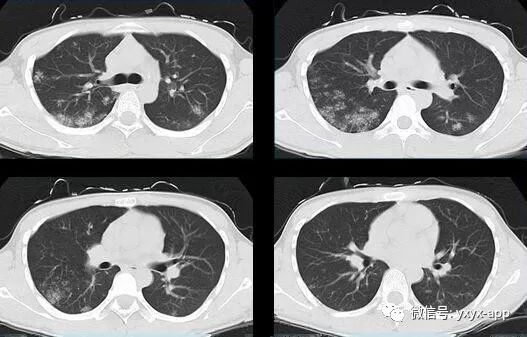 【病例】肺泡蛋白沉积症1例CT影像表现