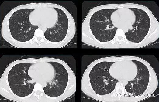 【病例】肺泡蛋白沉积症1例CT影像表现