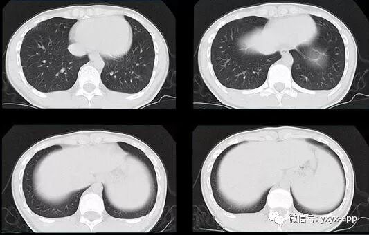 【病例】肺泡蛋白沉积症1例CT影像表现