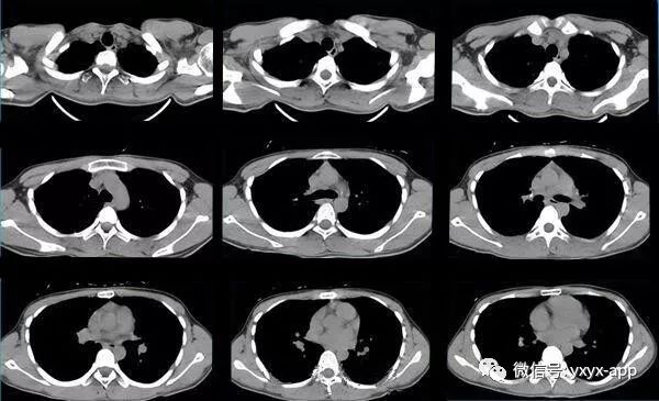 【病例】肺泡蛋白沉积症1例CT影像表现