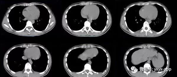 【病例】肺泡蛋白沉积症1例CT影像表现