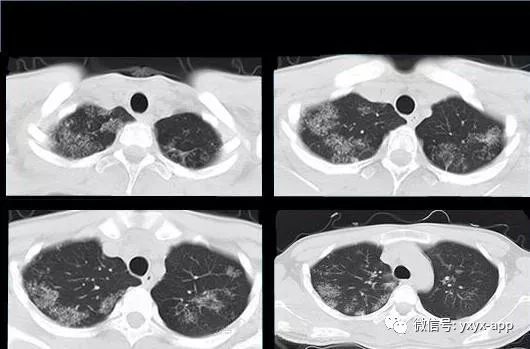 【病例】肺泡蛋白沉积症1例CT影像表现