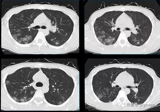 【病例】肺泡蛋白沉积症1例CT影像表现