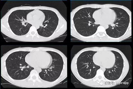 【病例】肺泡蛋白沉积症1例CT影像表现
