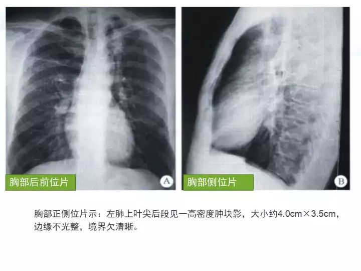 【病例】肺炎性肌纤维母细胞瘤1例CT影像表现