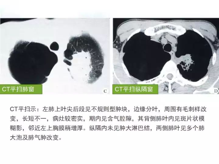 【病例】肺炎性肌纤维母细胞瘤1例CT影像表现