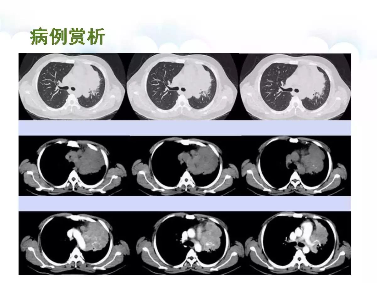 【病例】肺炎性肌纤维母细胞瘤1例CT影像表现