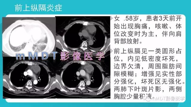 【PPT】纵隔肿瘤影像诊断（全）