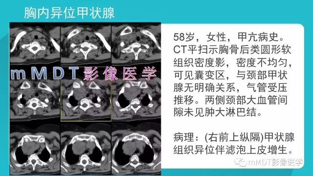 【PPT】纵隔肿瘤影像诊断（全）