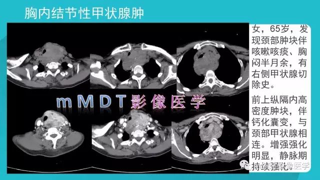 【PPT】纵隔肿瘤影像诊断（全）