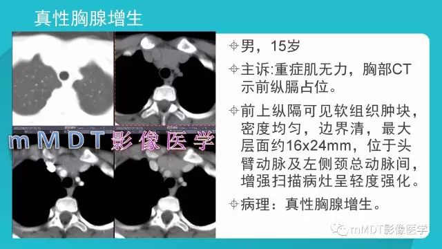 【PPT】纵隔肿瘤影像诊断（全）