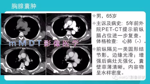 【PPT】纵隔肿瘤影像诊断（全）