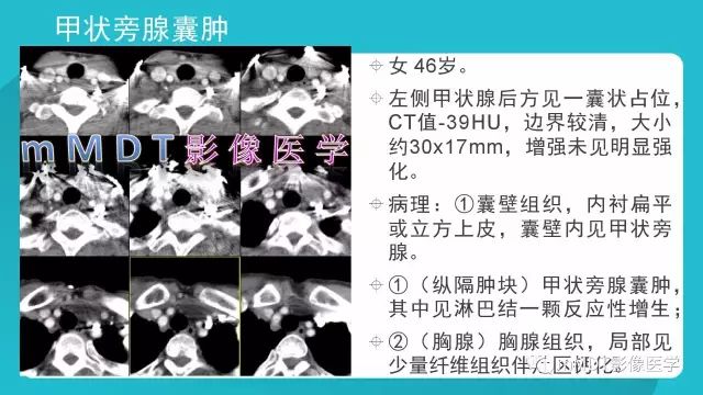 【PPT】纵隔肿瘤影像诊断（全）