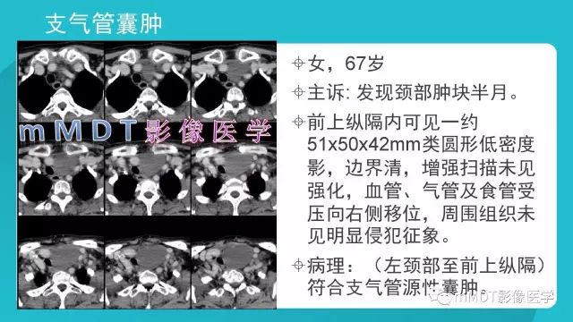 【PPT】纵隔肿瘤影像诊断（全）