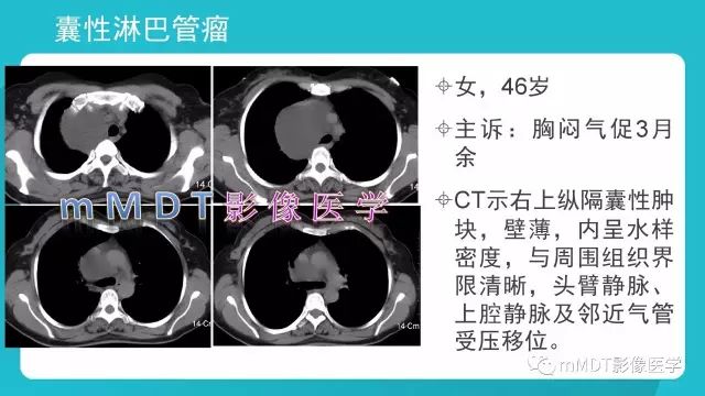 【PPT】纵隔肿瘤影像诊断（全）