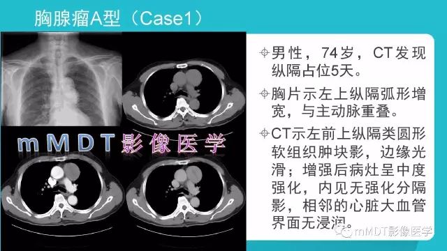 【PPT】纵隔肿瘤影像诊断（全）