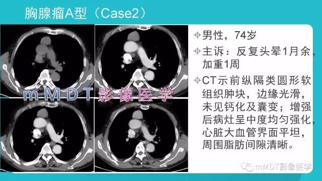【PPT】纵隔肿瘤影像诊断（全）