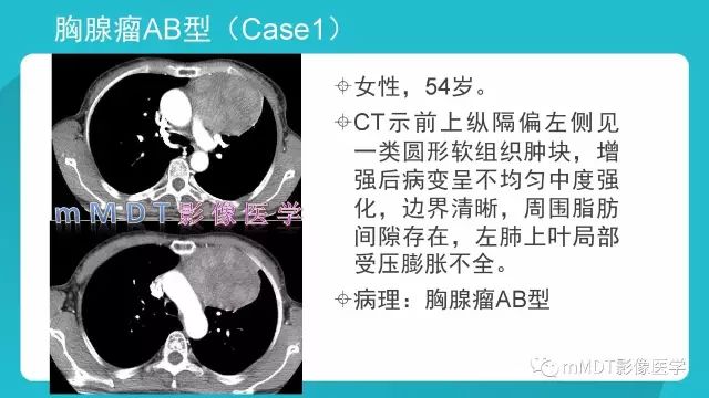 【PPT】纵隔肿瘤影像诊断（全）