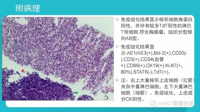 【PPT】纵隔肿瘤影像诊断（全）